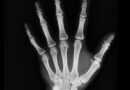 Romatoid Artrit (RA) Nedir? Tedavi Edilmezse Nelere Yol Açar? Tedavi Seçenekleri Nelerdir?